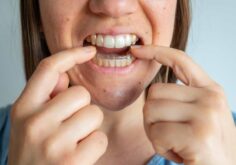 Can Aligners Treat a Crossbite